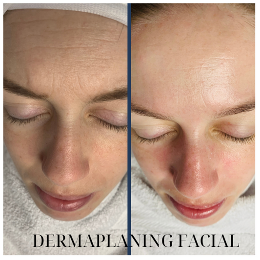 Dermaplaning Facial Voucher – Redeem at UDB Skin Clinic, Bow London