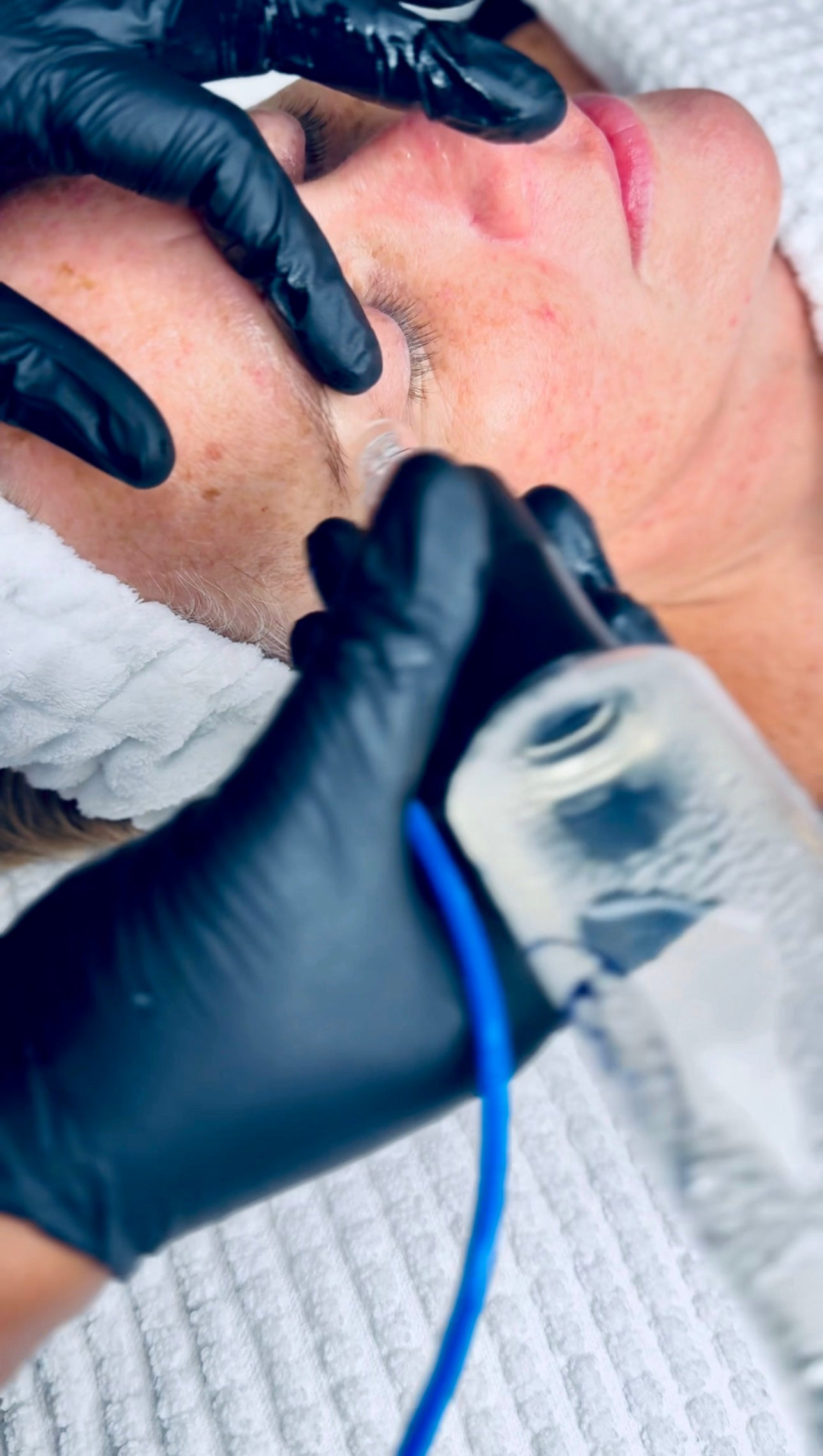 HydraFacial Voucher – Redeem at UDB Skin Clinic, Bow London