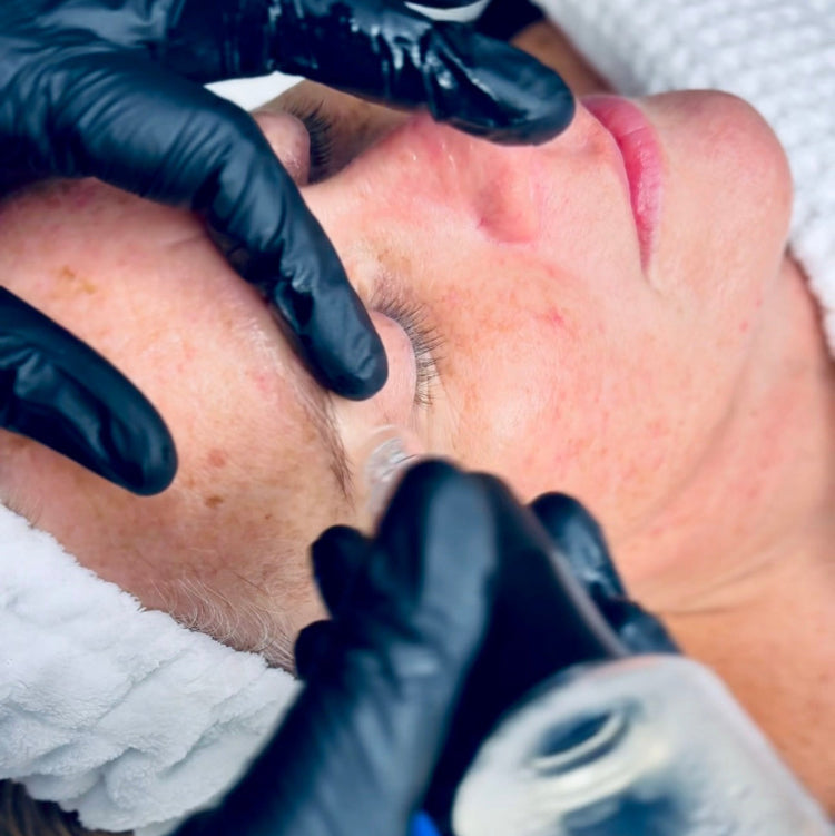 Woman receiving a facial HydraFacial treatment for dull tired skin IN EAST London