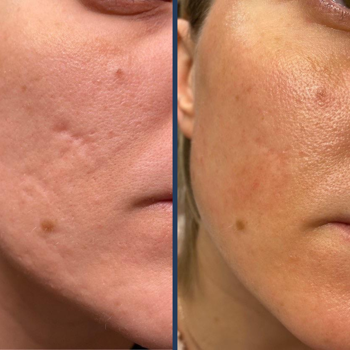 MICRONEEDLING_MESOTHERAPY