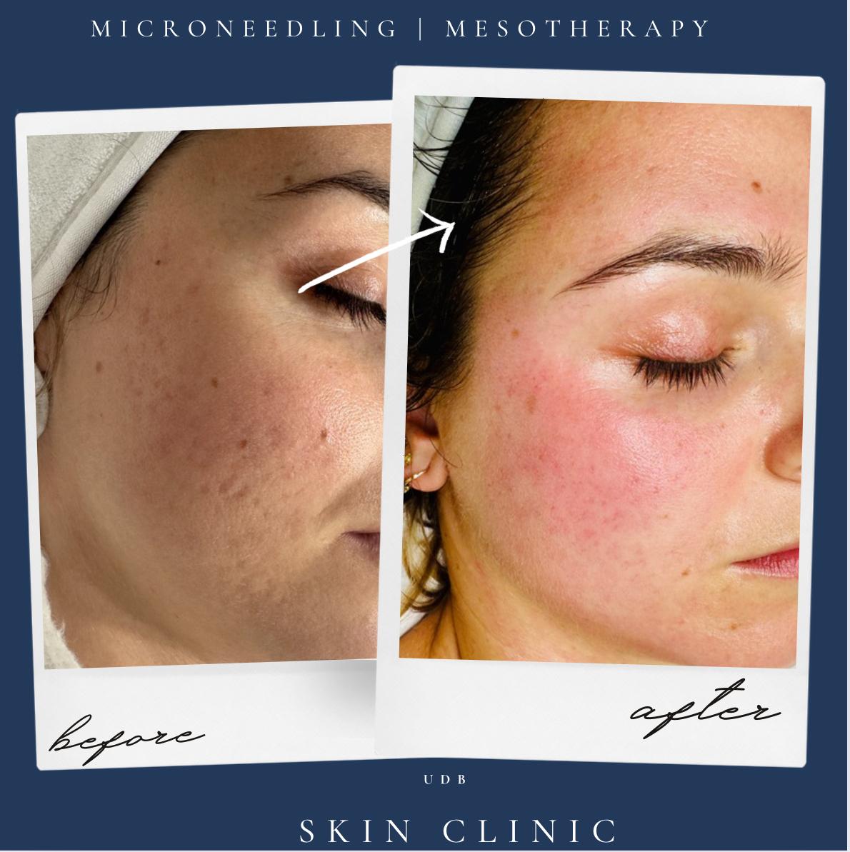 Microneedling Gift Voucher London | UDB Skin Clinic Bow