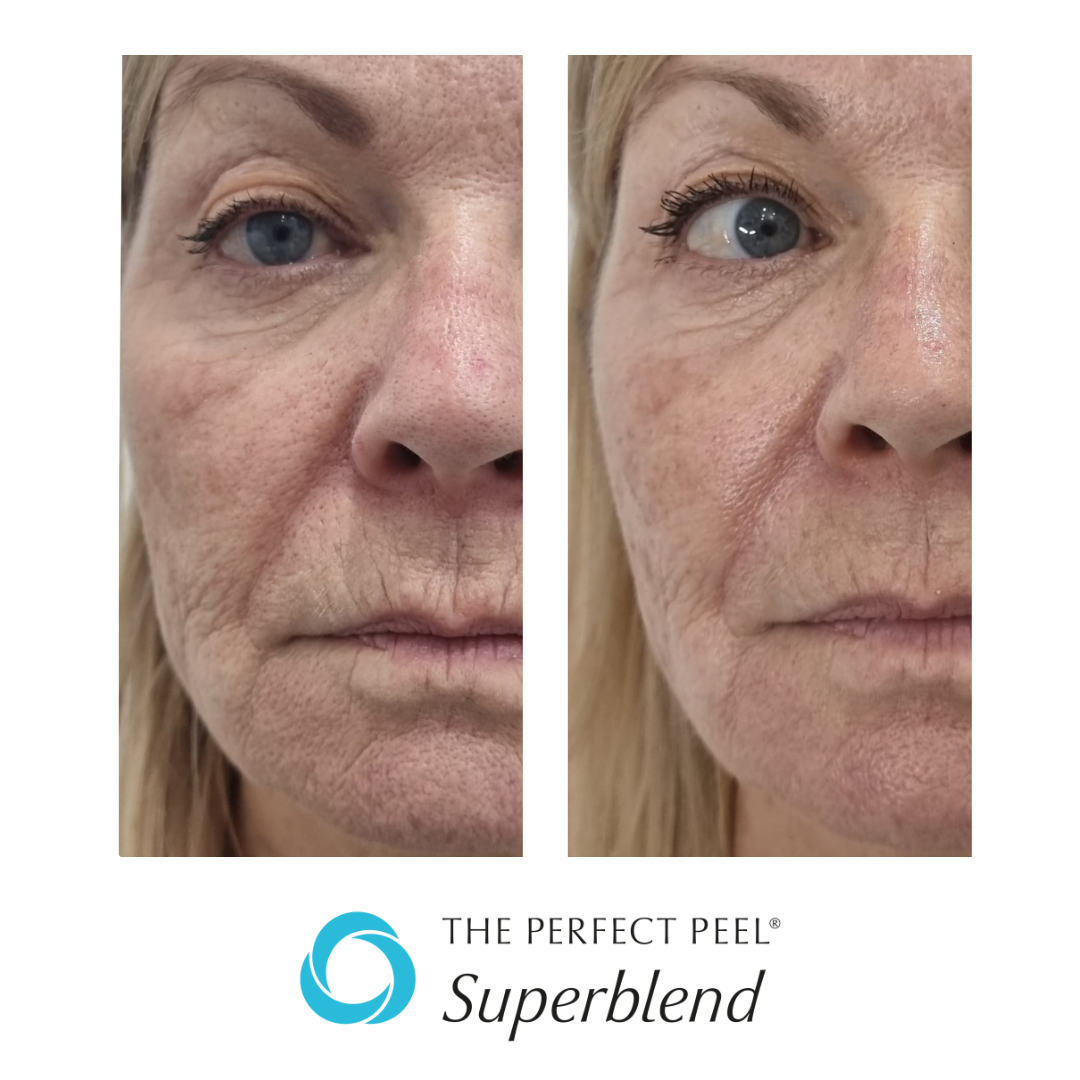 Perfect Peel Superblend - Chemical Peel Facial Voucher – Redeem at UDB Skin Clinic, Bow London